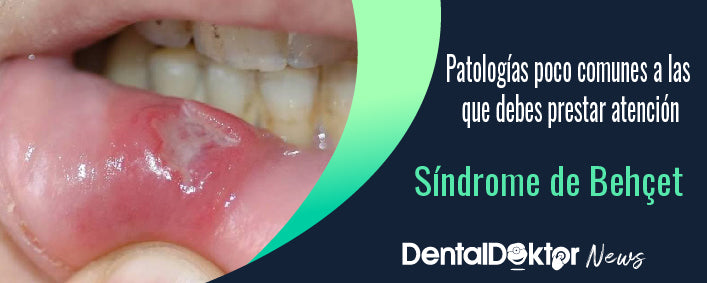 Conoce el Síndrome de Behçet. Causas, síntomas y tratamientos