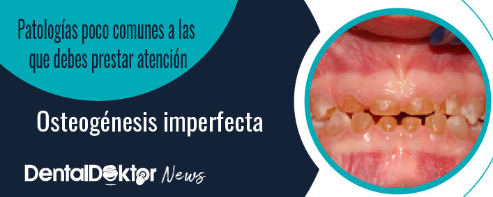 Conoce las causas de la Osteogénesis imperfecta, síntomas y tratamientos