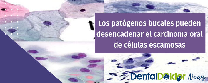 Los patógenos bucales pueden desencadenar el carcinoma oral de células escamosas