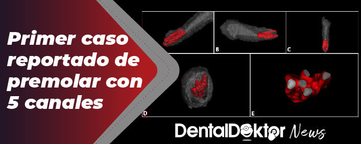 Primer caso reportado de premolar con 5 canales