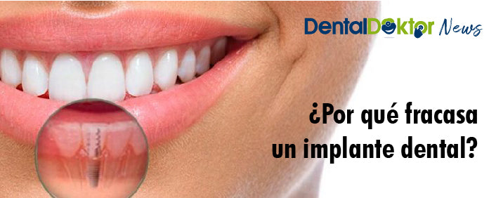 ¿Por qué fracasa un implante dental?