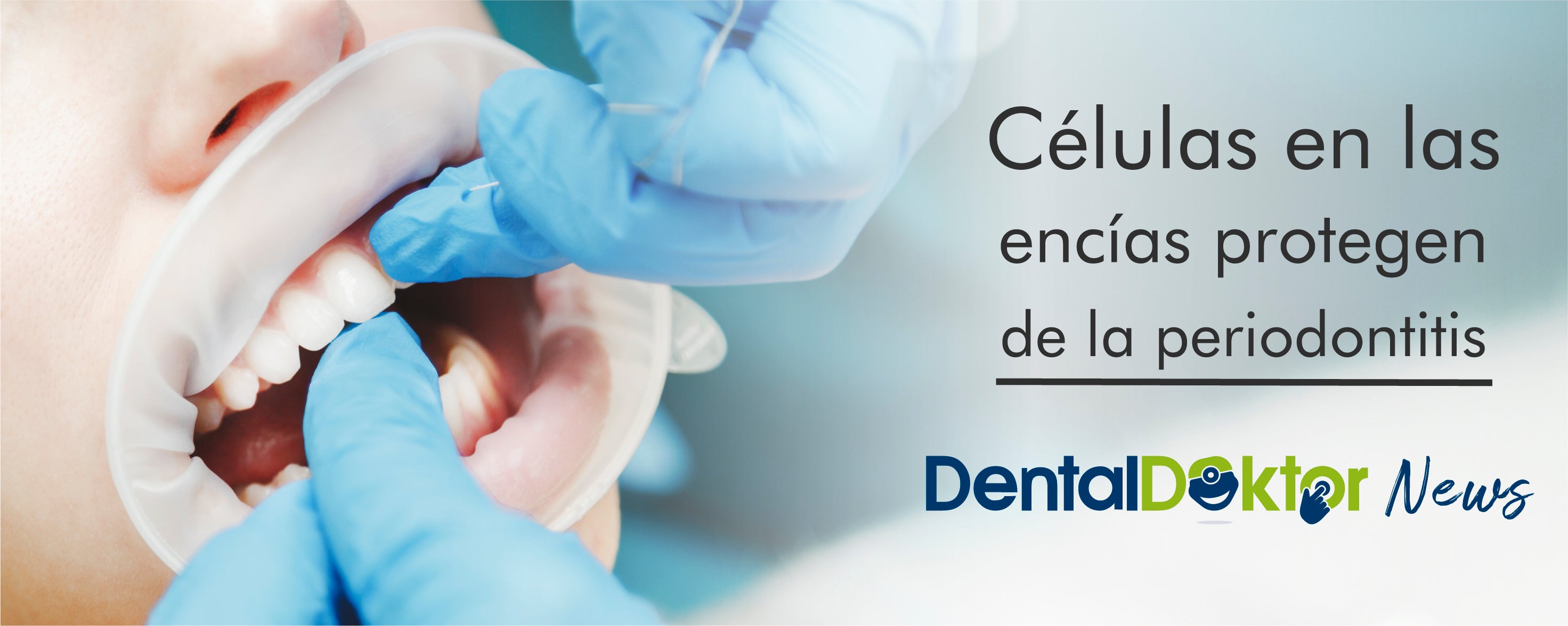 Hallan células en las encías que protegen de la periodontitis
